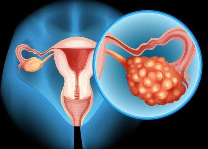 患了多囊卵巢吃药就能怀孕吗