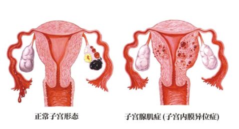 子宫内膜异位症病因有哪些？该如何治疗