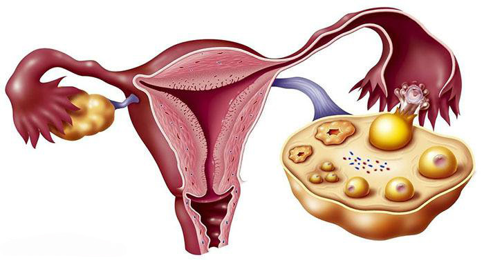 多囊卵巢综合征是什么原因呢