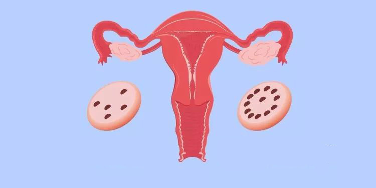 多囊卵巢的危害有哪些