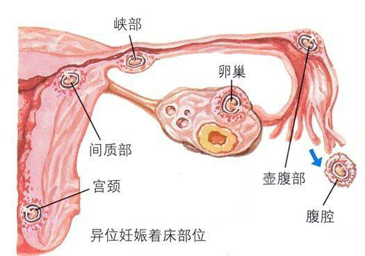 输卵管手术后能怀孕吗