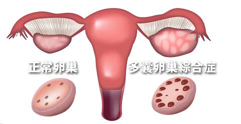 哪些女性容易患多囊卵巢综合征