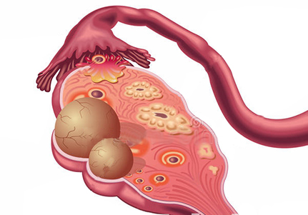卵巢囊肿有哪些危害