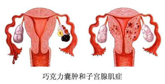 子宫内膜异位症会出现哪些症状